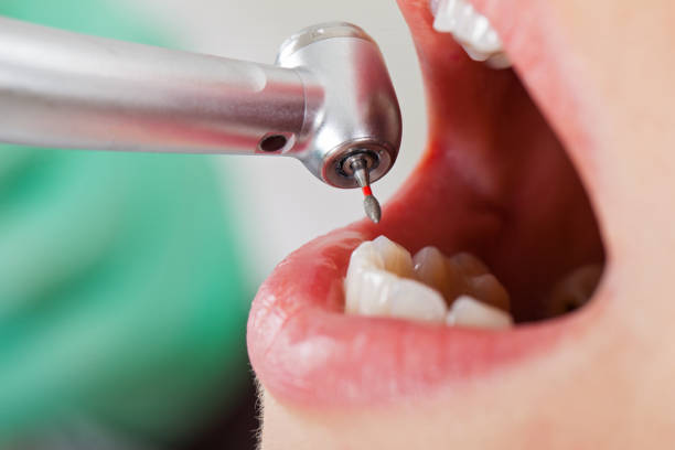 Best Knocked-Out Tooth (Avulsed Tooth) Treatment in Lewisburg, OH